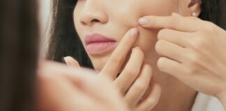 Acne Face Map Causes and Solutions: Figuring Out What Your Pimples Are Trying To Tell You