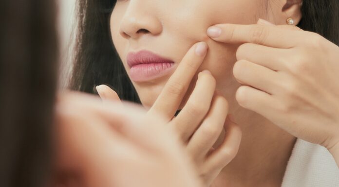 Acne Face Map Causes and Solutions: Figuring Out What Your Pimples Are Trying To Tell You