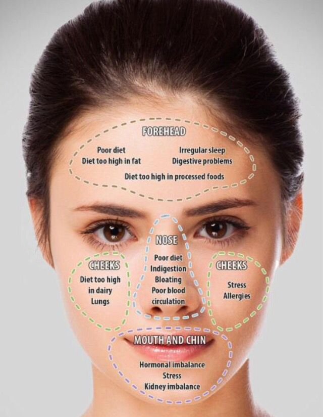 Acne Face Map Causes And Solutions Acne Face Map Guide